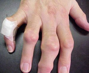 fingers with deformed joints cause pain