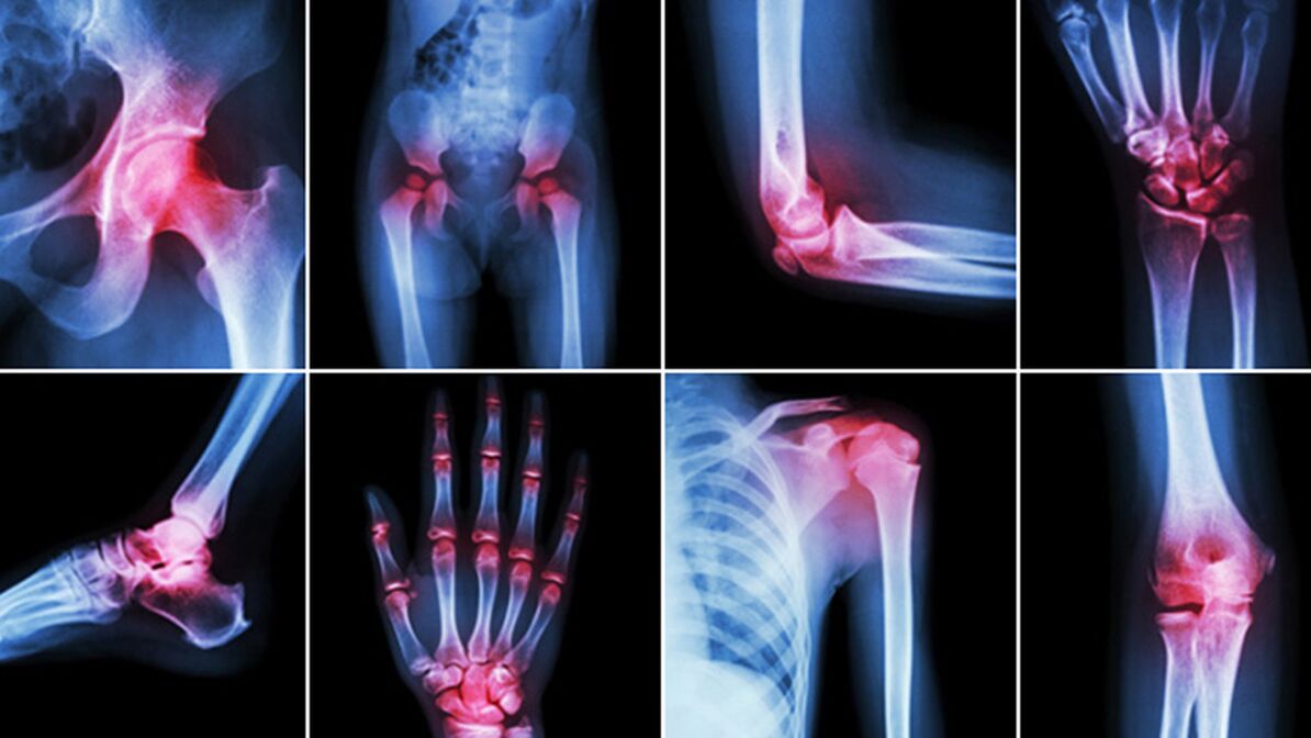 X-rays for joint pain