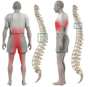 back pain in thoracic osteochondrosis
