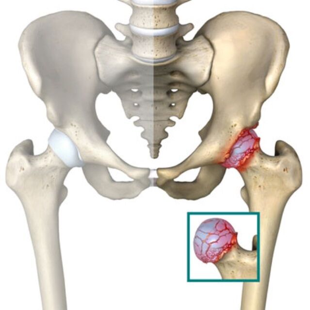 osteoarthritis of the hip