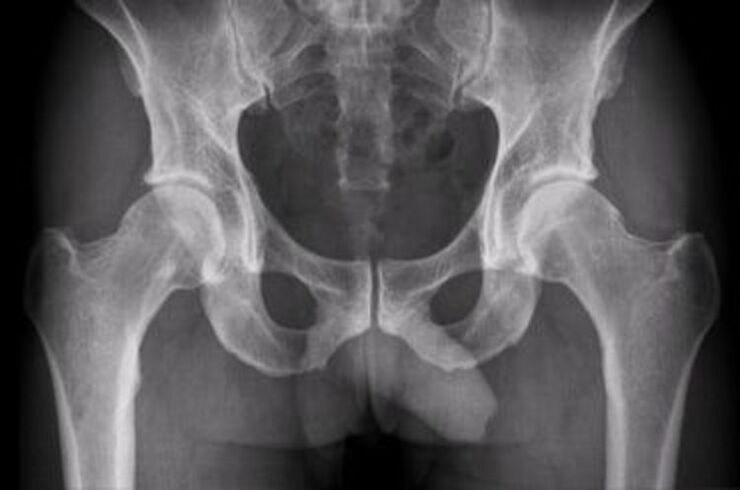 X-ray of the hip joint for pain