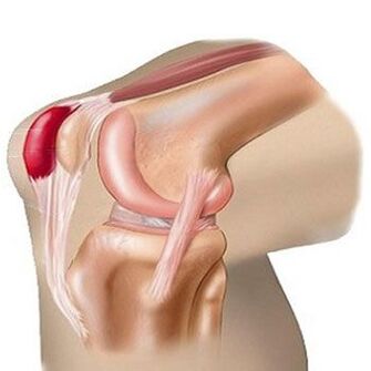 One of the causes of pain in the knee joint is bursitis. 