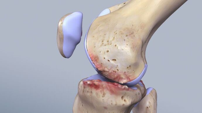 The structure of the knee joint affected by the pathology