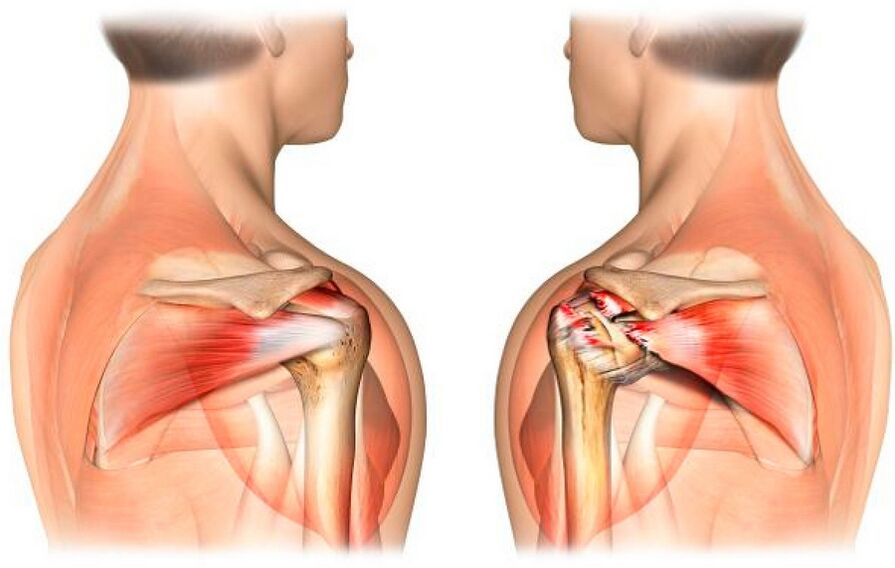 Healthy and arthrosis-affected shoulder