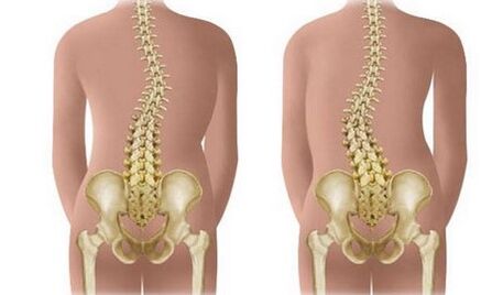 Scoliosis not -resistant