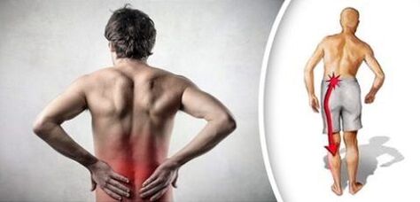Pain syndrome with lumbar osteochondrosis radiates in the legs