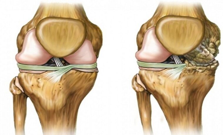 Healthy and affected by the union of arthrosis