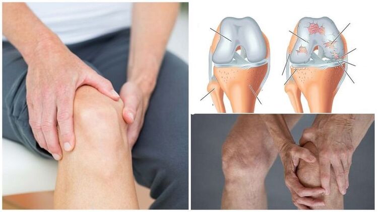 Symptom of knee pain of knee arthrosis