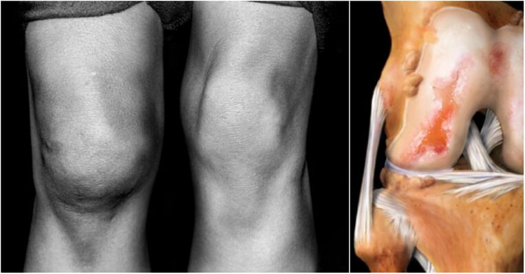 knee joint arthrosis and sore joint