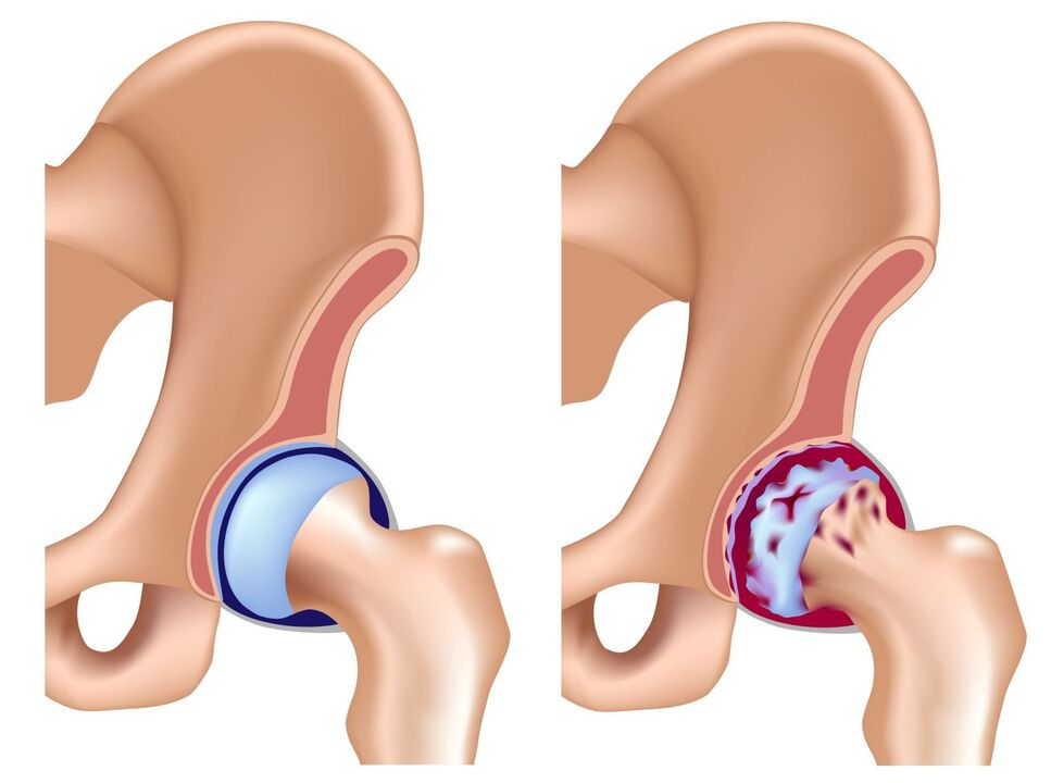 Comparison of a healthy joint and arthrosis