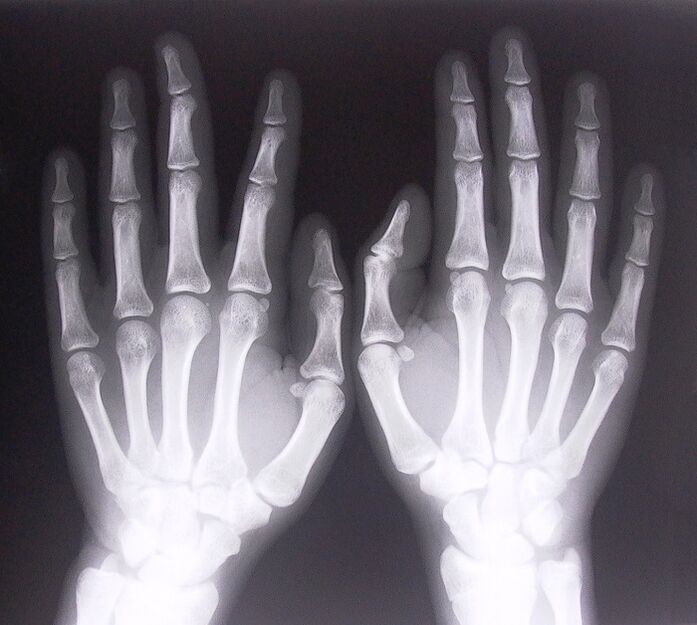 X-rays as a way to diagnose pain in the joints of the fingers