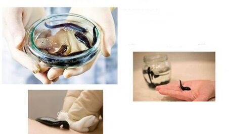 Hirudotherapy for arthrosis