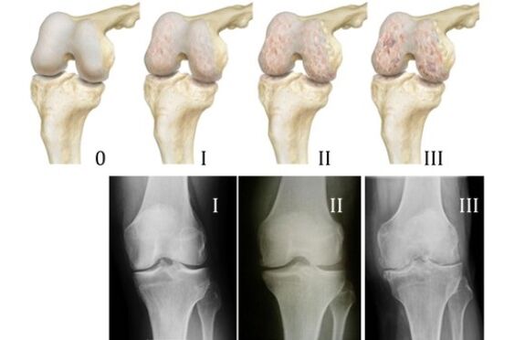 Methods for diagnosing knee arthrosis